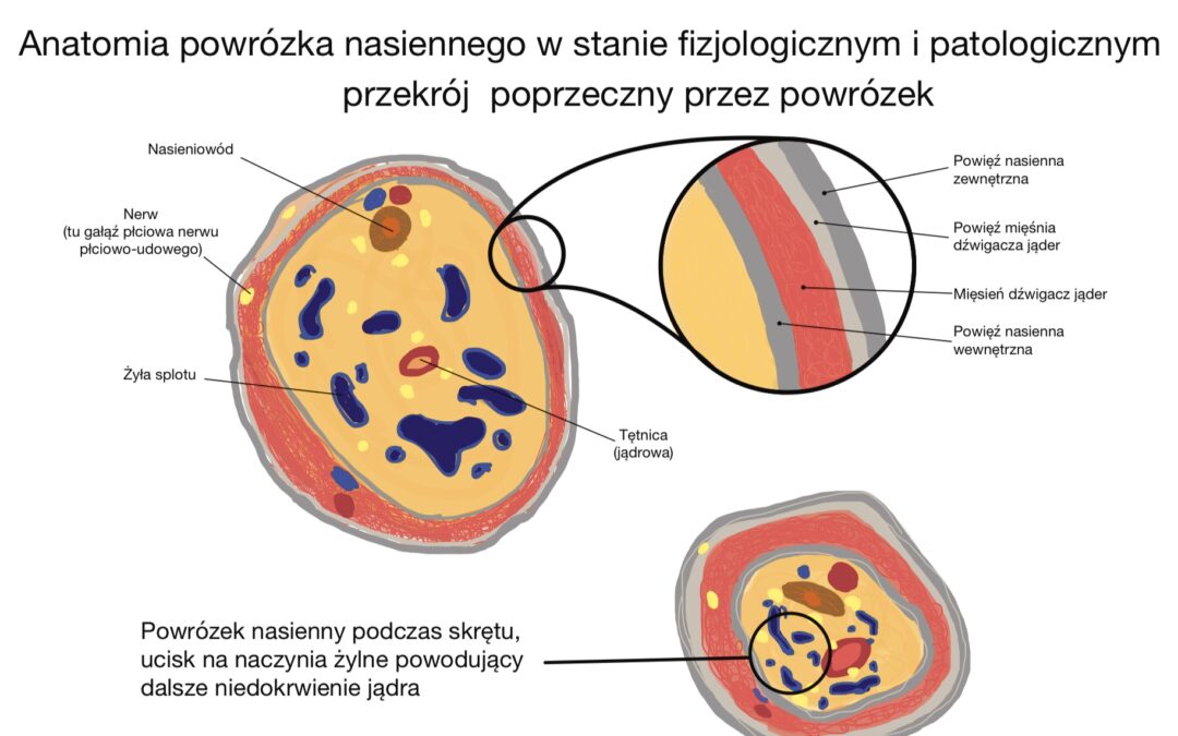 Skręt i amputacja męskości